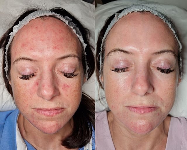 Before and after photographs of a client's cheek and temple, taken either side of a facial treatment at STRATA