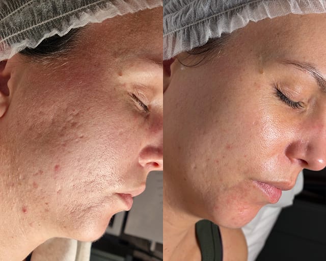 Before and after photographs of a client's face, taken either side of a facial treatment at STRATA