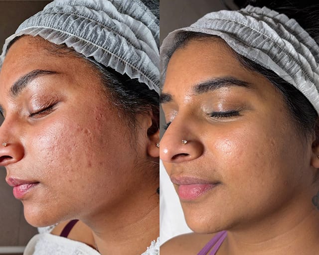 Before and after photographs of a client's cheek and jaw, taken either side of a facial treatment at STRATA