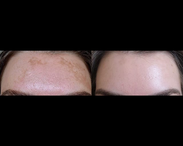 Before and after photographs of a client's face, taken either side of a facial treatment at STRATA