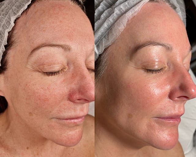 Before and after photographs of a client's cheek, taken either side of a facial treatment at STRATA