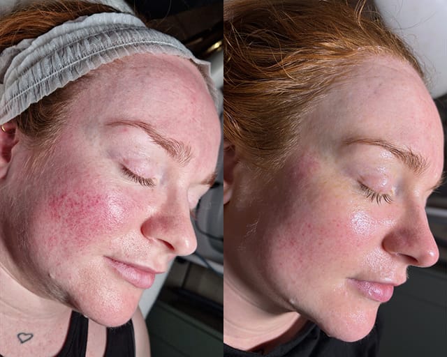 Before and after photographs of a client's face, taken either side of a facial treatment at STRATA