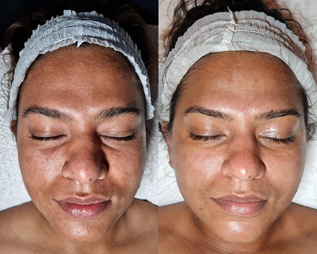 Before and after photographs of a client's face, taken either side of a facial treatment at STRATA
